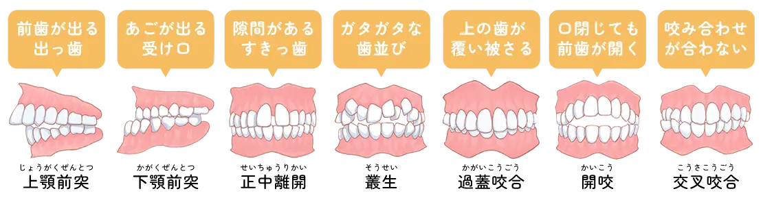 悪い歯並び