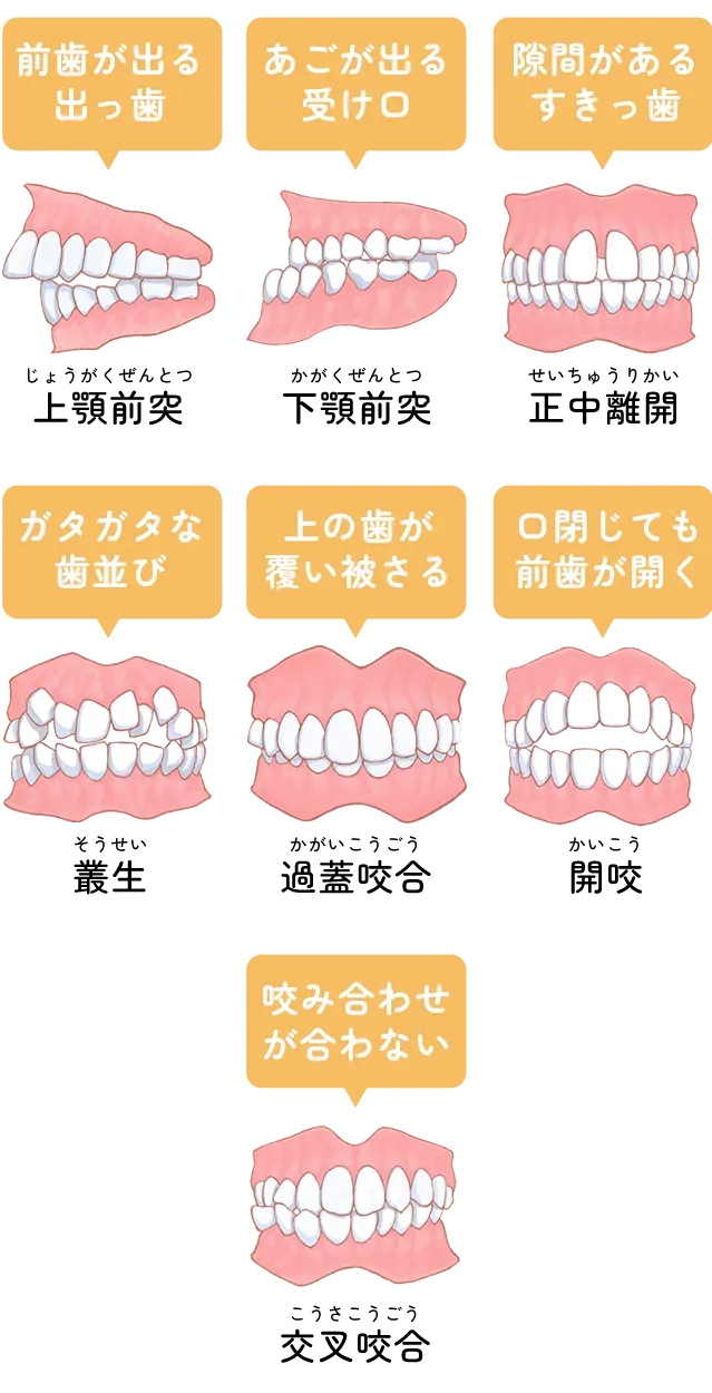 悪い歯並び