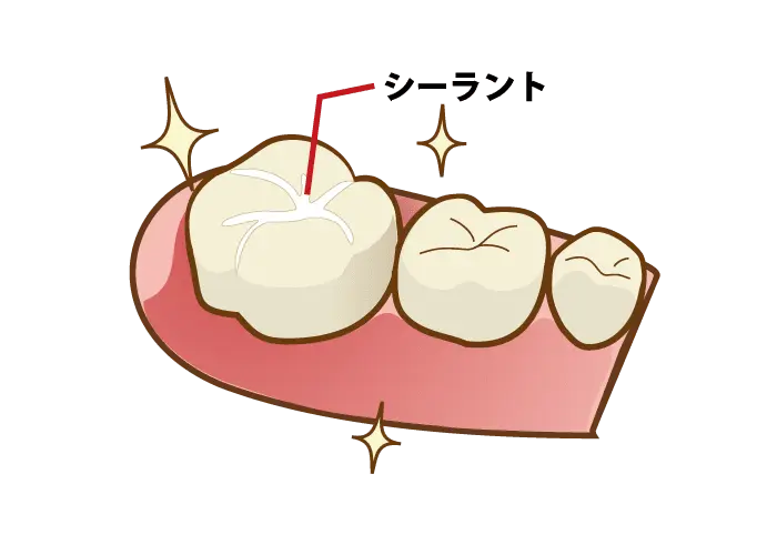 シーラント