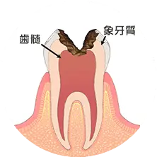 歯の神経まで達した虫歯