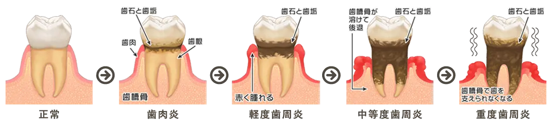 歯周病の進行