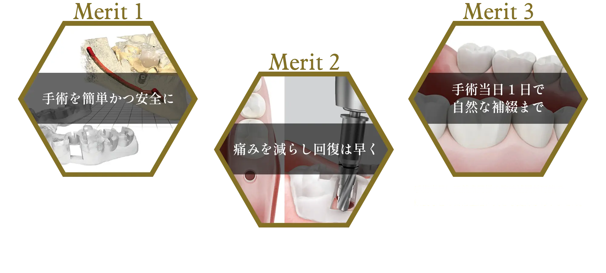 オステムワンガイドの特長