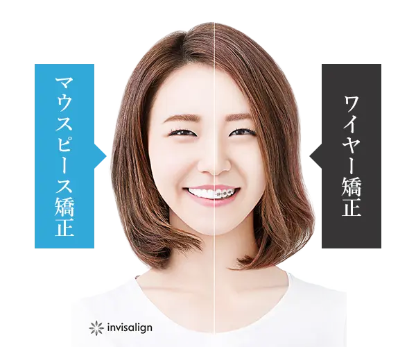 矯正治療の比較